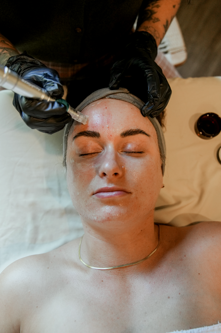 Practitioner performing a facial microneedling treatment