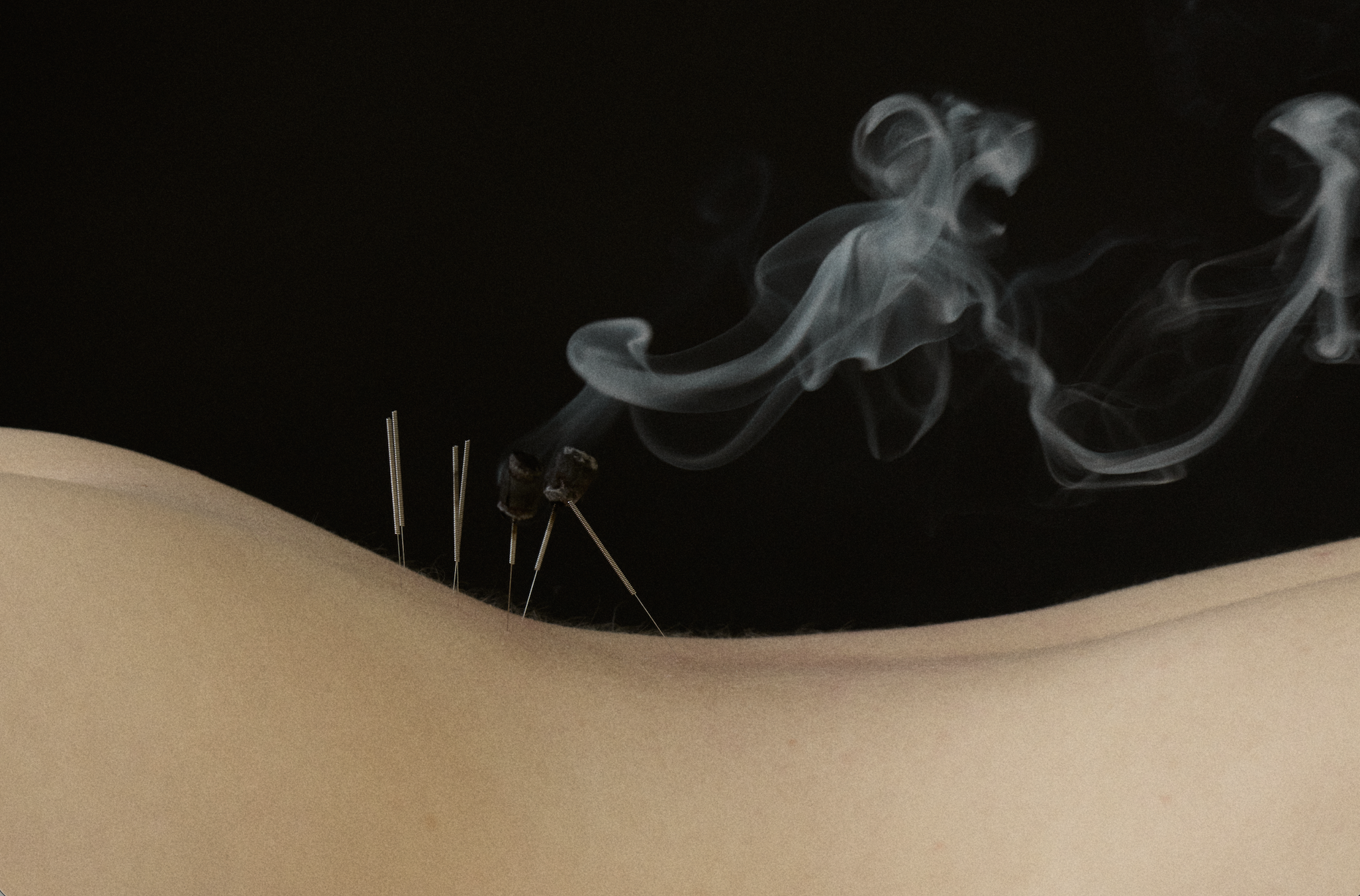 Moxibustion with acupuncture needles during a treatment