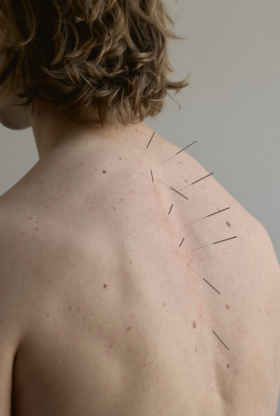 What to expect at your first acupuncture visit