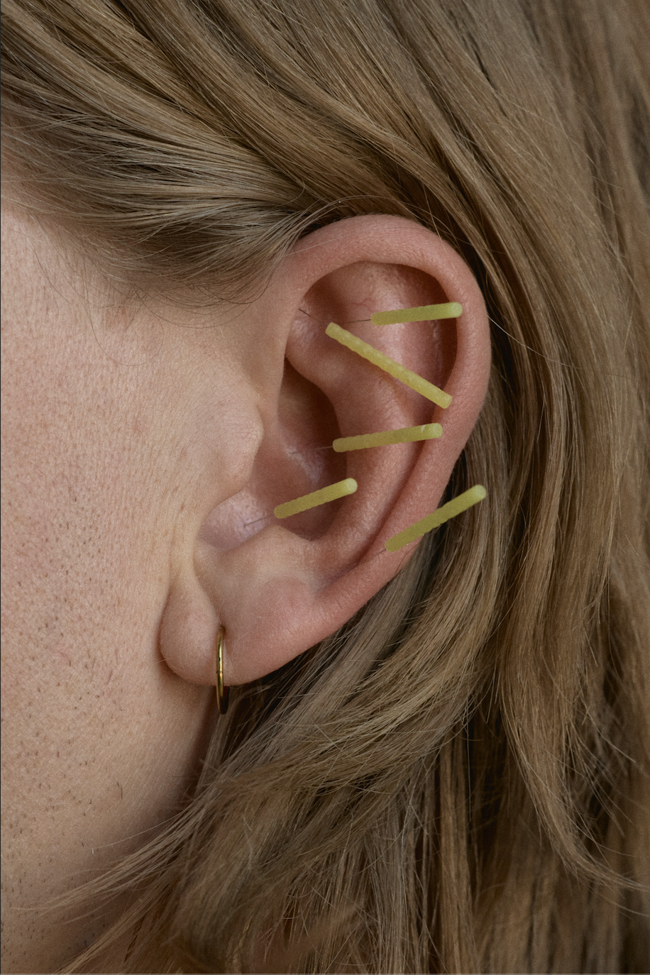 Close view of acupuncture needles placed in the outer ear