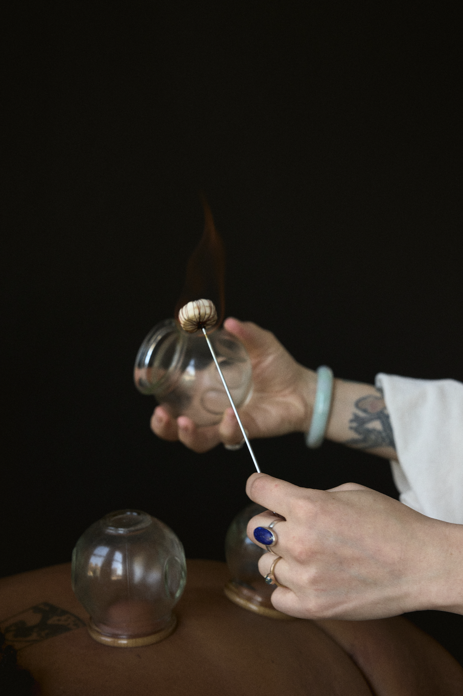 Practitioner preparing a glass cup for fire cupping